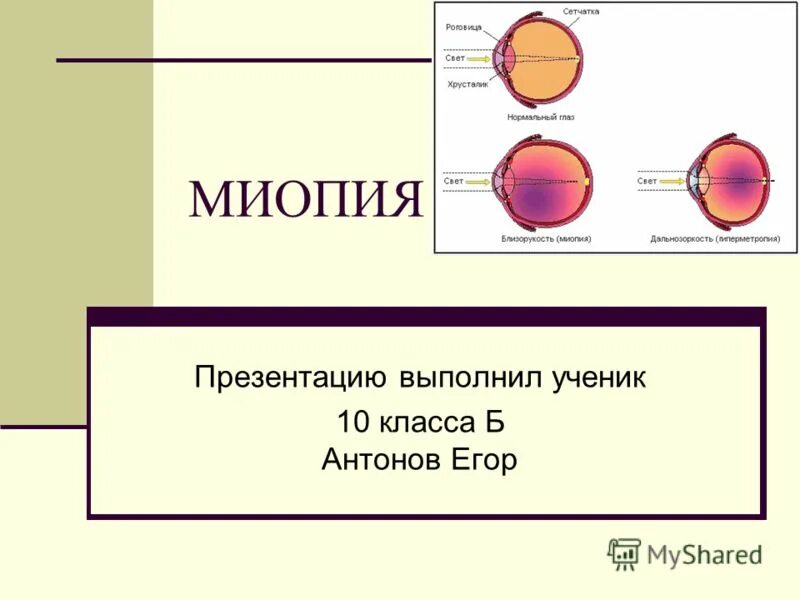 миопия. зрение человека дальнозоркость и близорукость. заболевание органов зрения миопия. близорукость. миопия сообщение.