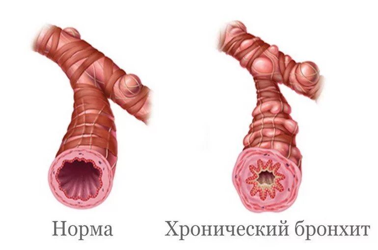 Бронхит у человека. Катаральный эндобронхит. Хронич катаральный бронхит. Диффузионный катаральный эндоьронхит. Диффузный эндобронхит.