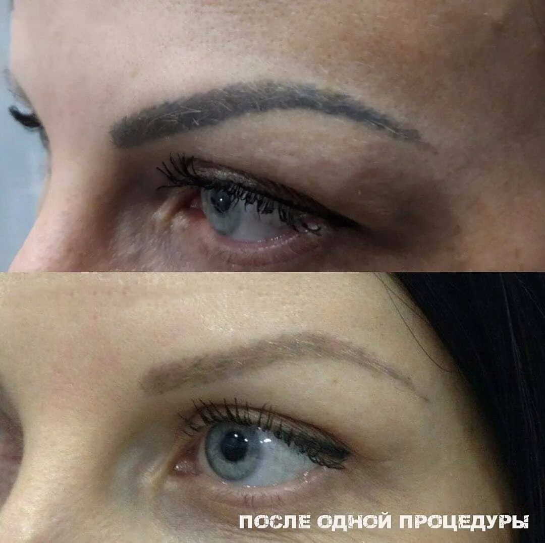 Как удалить татуаж бровей. Коррекция татуажа бровей лазером. сведение татуажа бровей лазером. сведение перманентного макияжа бровей. коррекция цвета бровей лазером.