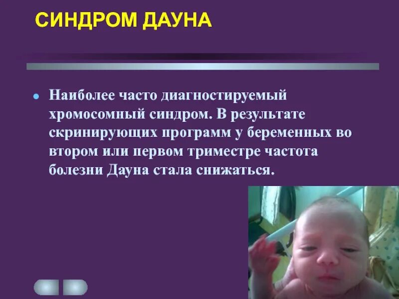 Синдром 3 триместра. Синдром Дауна. Синдром Дауна симптомы при беременности. Синдром Дауна определение. Синдром Дауна у беременных.