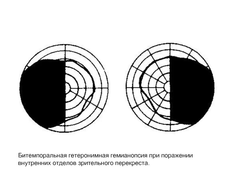 Правосторонняя гомонимная гемианопсия очаг поражения. Верхнеквадрантная правосторонняя гемианопсия. Схема гетеронимная гемианопсия. Выпадение участков поля зрения. Квадрантная гемианопсия возникает при поражении.