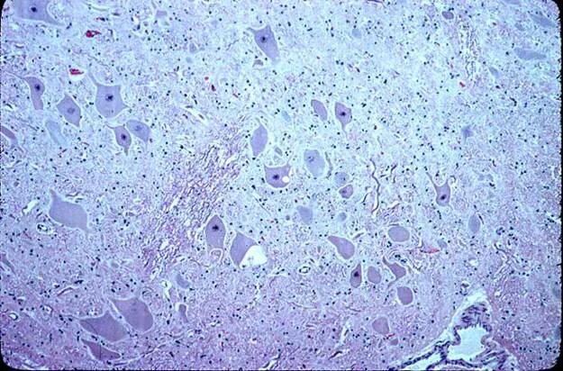 Энцефалопатия гистология. Губкообразная энцефалопатия КРС гистология. Гипертензионная энцефалопатия гистология.