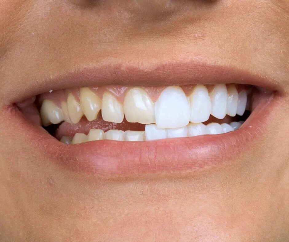 Что такое виниры в стоматологии. Микропротезы виниры вкладки стоматология. Виниры люминиры ультраниры. Фотокомпозитные виниры. Что такое виниры в стоматологии.