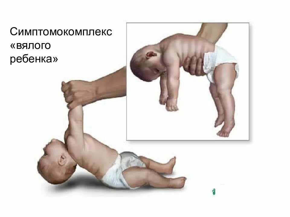 Родился слабый ребенок. ДЦП мышечный тонус параличи. Гипертонус и гипотонус мышц у ребенка. Нарушение мышечного тонуса при ДЦП. Мышечный тонус.