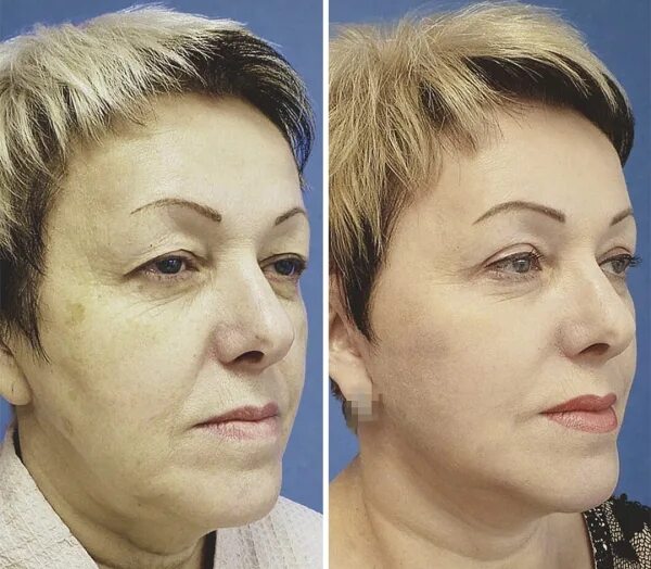 Актриса и продюсер Анастасия Калманович помолодела на 10 лет после пластики