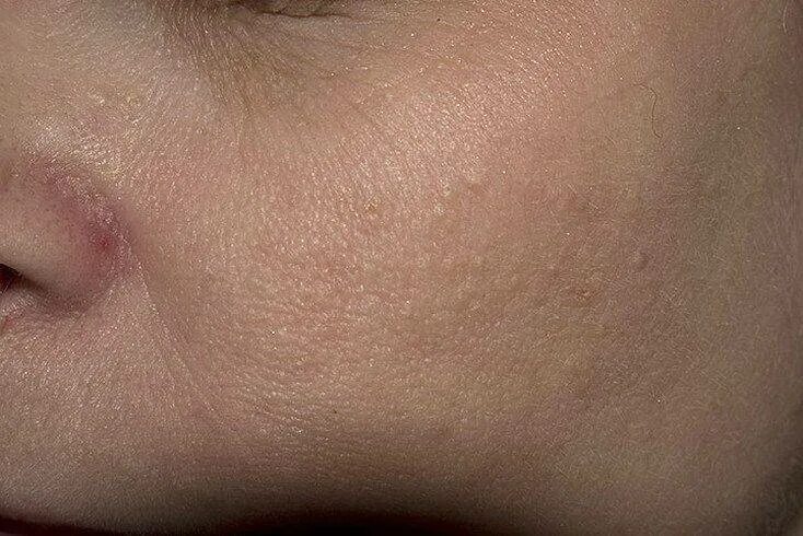File:Superficial subcutaneous lipoma.jpg - Wikipedia