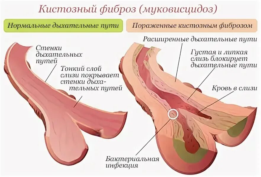 Фиброз что это такое. Фиброз половых органов.