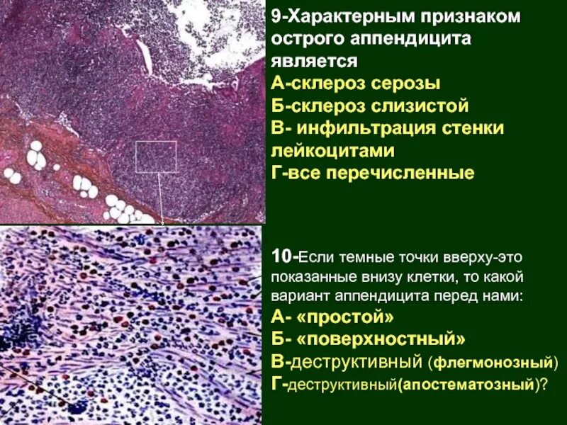 Флегмонозно язвенный аппендицит патанатомия. Флегмонозный аппендицит препарат. Флегмонозно язвенный аппендицит микропрепарат. Флегмонозный аппендицит препарат патанатомия.