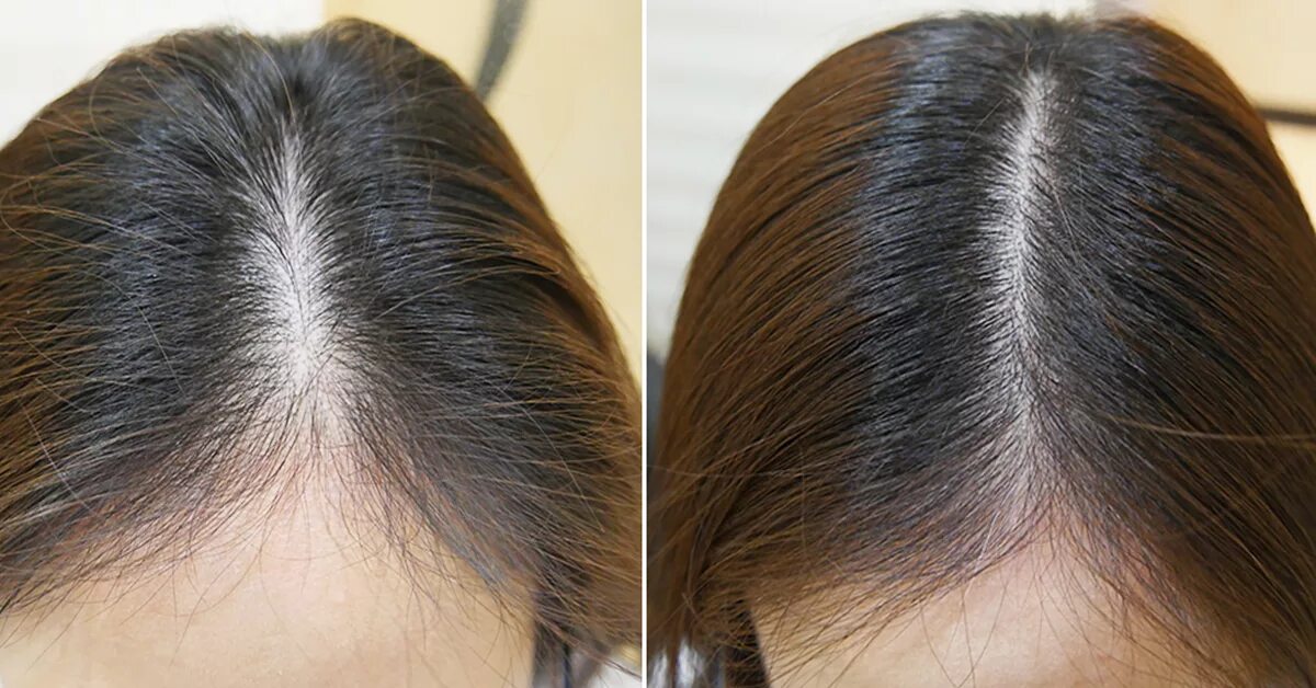 Как восстановить рост волос. Мезотерапия волос до и после. Выпадение волос до и после. Мезотерапия кожи головы до и после. Мезо волос до и после.