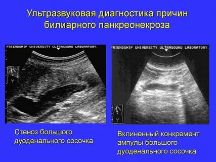 Билиарный панкреатит