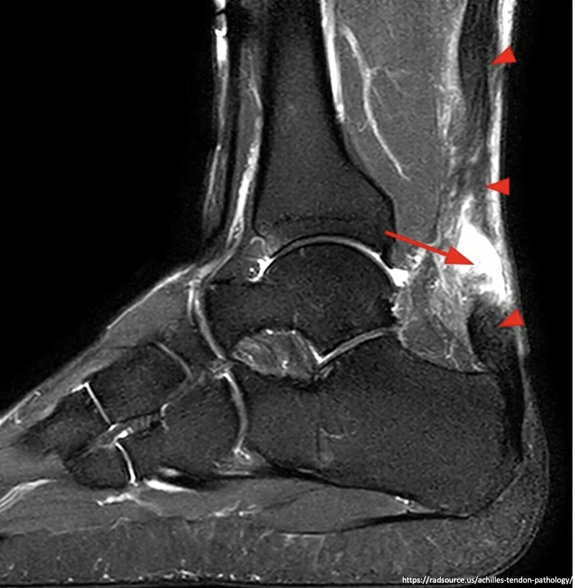 Диагноз голеностопный сустав. Синовит голеностопного сустава на мрт. Тендинит пяточного сухожилия рентген. Повреждение ахиллова сухожилия мрт. Ахиллово сухожилие разрыв мрт.