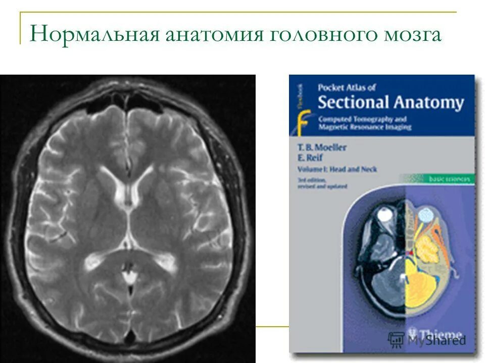 Доли мозга мрт. Топографическая анатомия головного мозга мрт. Доли головного мозга мрт анатомия. Цистерны головного мозга на мрт анатомия. Мрт анатомия головной мозг учебник.