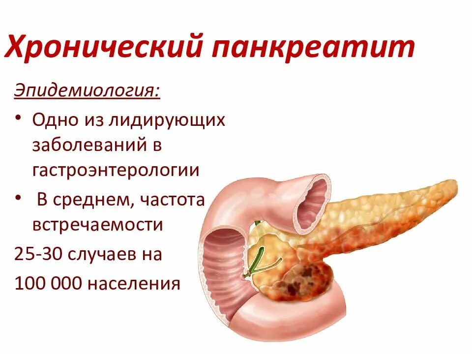 Заболев поджелудочной железы. Хронический панкреатит поджелудочная железа. болезнь хронический панкреатит поджелудочной железы. острый панкреатит поджелудочной железы. панкреатит это заболевание поджелудочной железы.