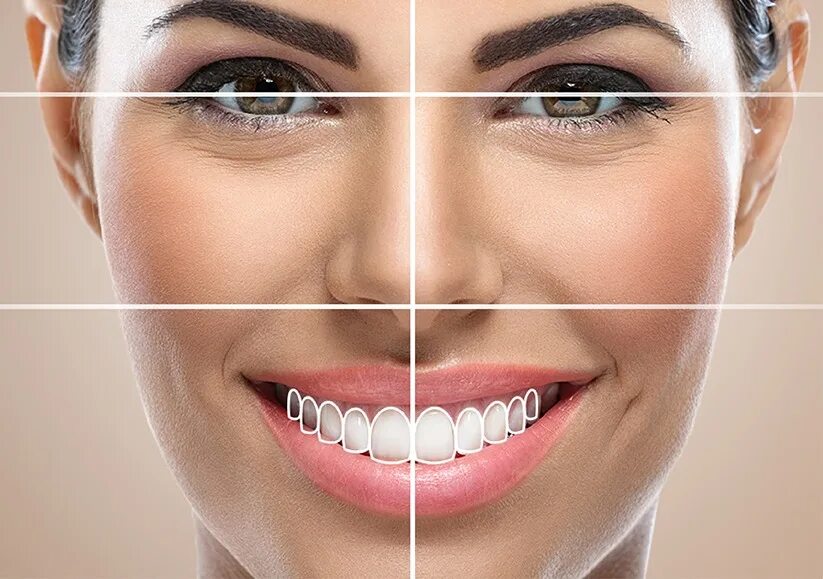 Smile design