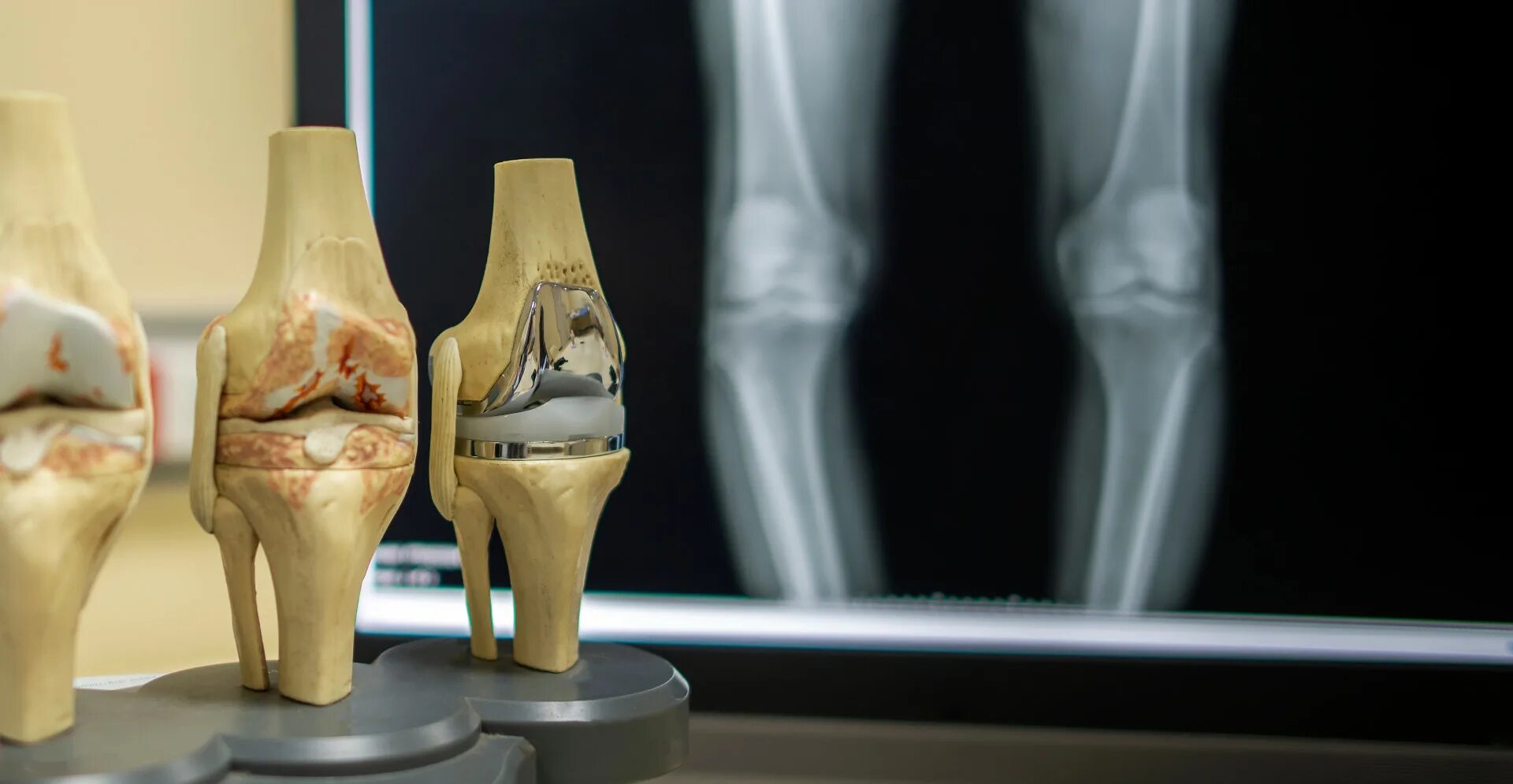 Деформирующий гонартроз коленного сустава. Гонартроз остеоартроз. Гонартроз (остеоартроз коленного сустава). Деформирующий остеоартроз коленного сустава эндопротез.