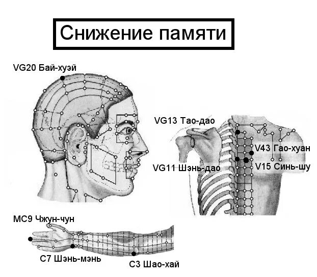 Иглоукалывание при неврозе