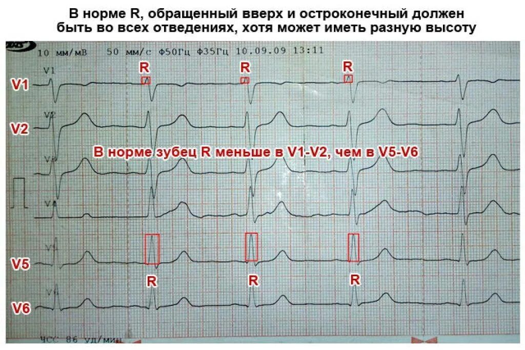 Кардиограмма сердца показатели нормы таблица. Норма ЭКГ У взрослых расшифровка. ЭКГ отведение v5 норма. ЭКГ норма 25 мм. Тяжелое экг