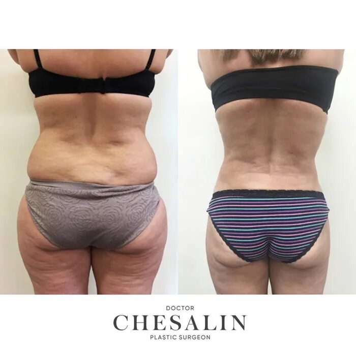 липофилинг тела