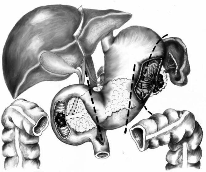 Операция по удалению печени. Корпорокаудальная резекция поджелудочной железы. Цистаденома поджелудочной железы. Резекция хвоста поджелудочной железы. Панкреатодуоденальная резекция.
