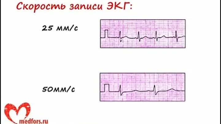 Скорость записи экг 50 мм с. Скорость записи 50 мм в сек экг. Стандартная скорость экг. Стандартная скорость экг. Стандартная скорость экг.