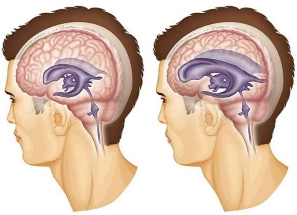 Причины гидроцефалии мозга. Гидроцефалия головного мозга. Гидроцефалия головного мозга у взрослого. Гидроцефалия водянка головного мозга. Внутричерепная (гидроцефалия и трансфеноидальная) эндоскопия;.