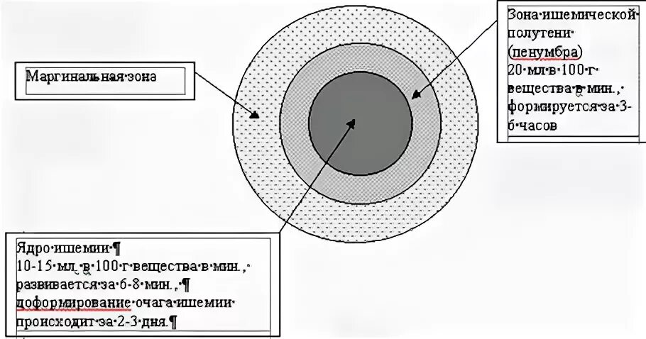 Зона ишемии. Очаг ишемии зона Пенумбры. Ишемический инсульт Пенумбра. Ишемическая полутень Пенумбра. Ядро ишемии зона Пенумбра.