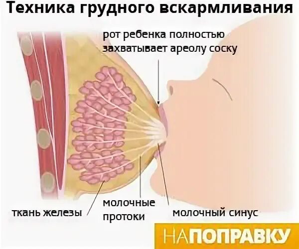 Уплотнение при гв болит. Мастопатия молочной железы причины. Уплотнение при гв болит. Признаки онкологии груди. Интрамаммарный гнойный мастит разрезы.