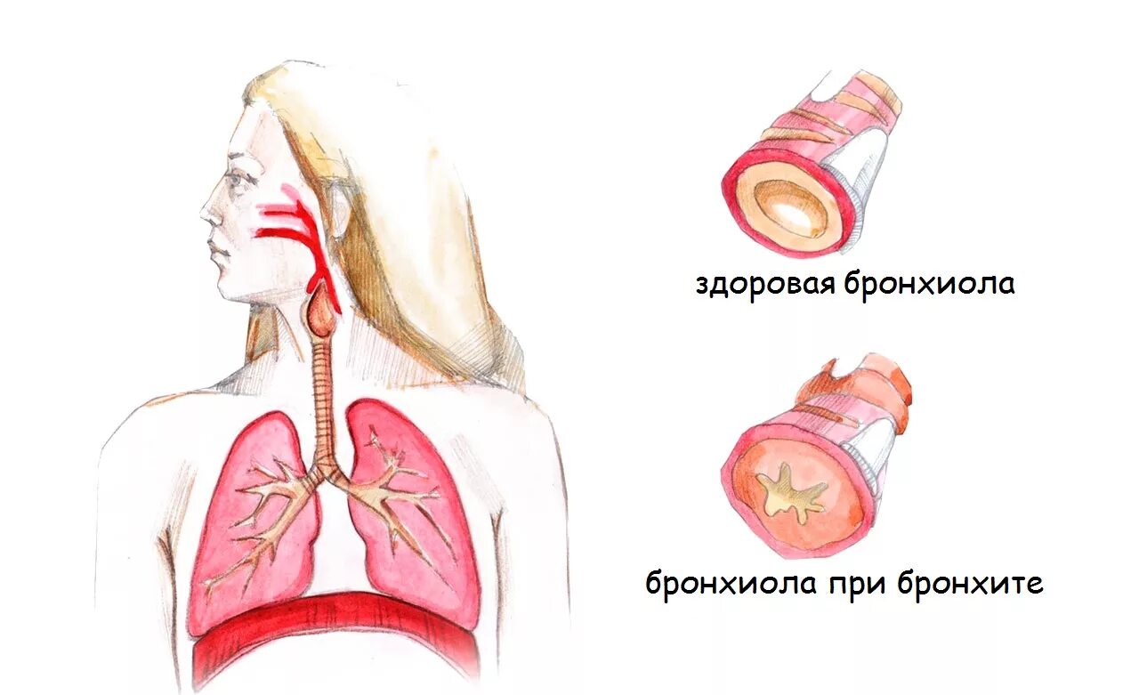 Трахеобронхит без кашля