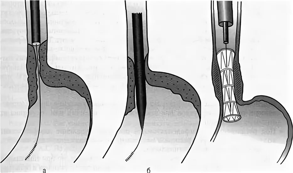 Стеноз пищевода бужирование. Ретроградное бужирование пищевода. Баллонная дилатация стеноза пищевода. Стеноз прямой