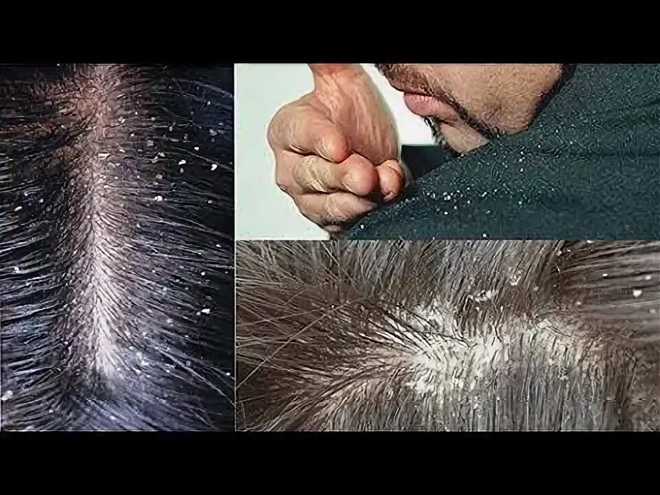 Como Eliminar a Caspa, Seborreia e Fazer Crescer Muito o Cabelo! - YouTube