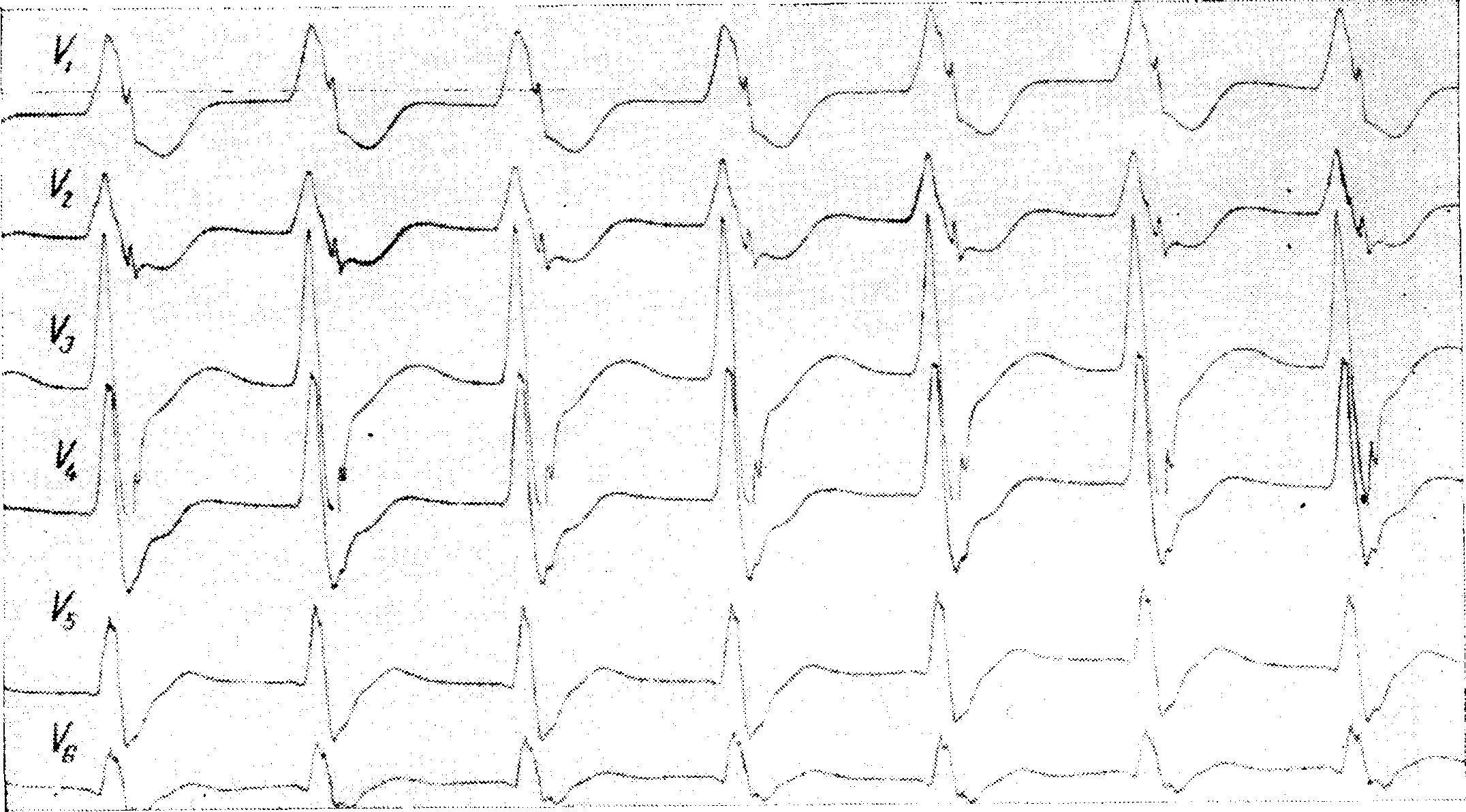 Тахикардия qrs. Деформация комплекса qrs на экг. уширение комплекса qrs на экг. пейсмекерные тахикардии на экг. пейсмейкерная тахикардия на экг.