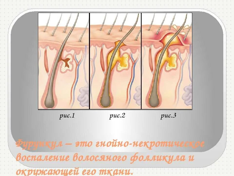 Фолликулит волосяного фолликула. Фурункулез волосяных фолликулов. Фурункул волосяной луковицы. Воспаление волосяного фолликула.