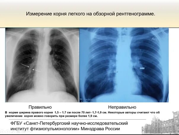 Патология корня легкого рентген. Расширение корня легкого на рентгене. Корень легкого на рентгенограмме. Легочные корни расширены