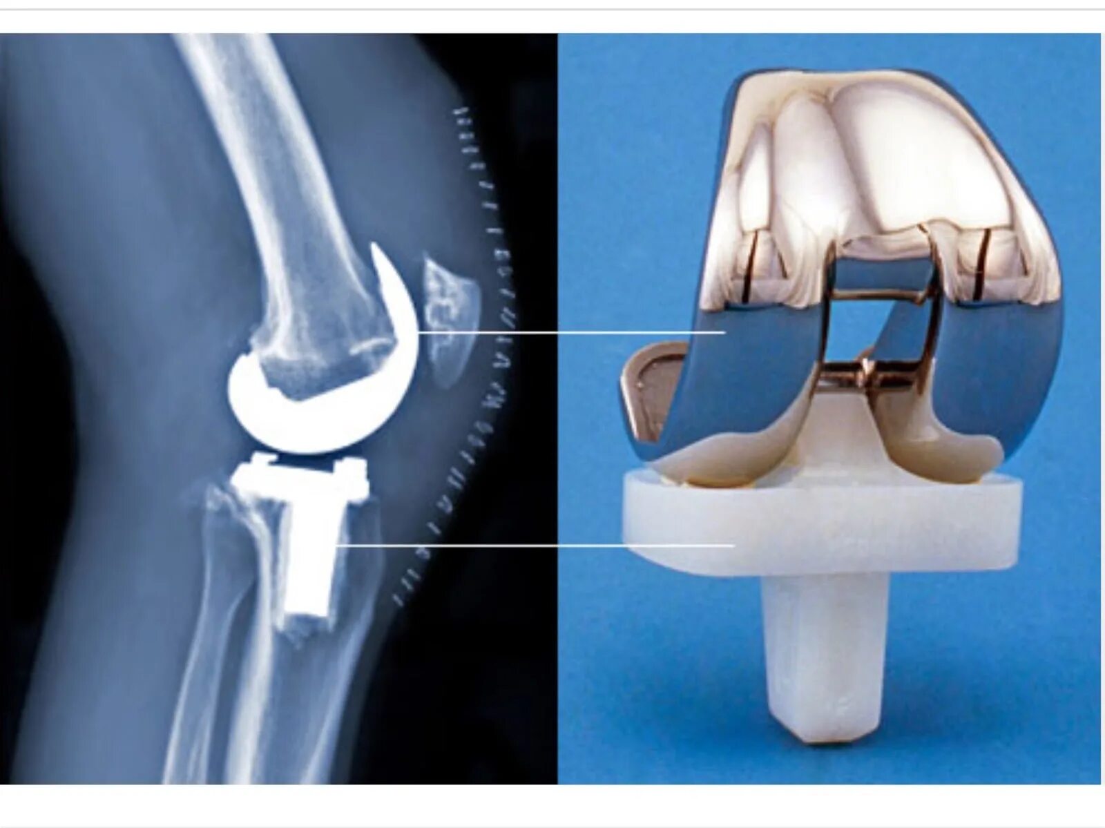 Цито коленный сустав. Эндопротез коленного сустава Stryker. Эндопротезирование коленного Зиммер. Эндопротез коленного сустава рентген. Эндопротез Зиммер коленного сустава.