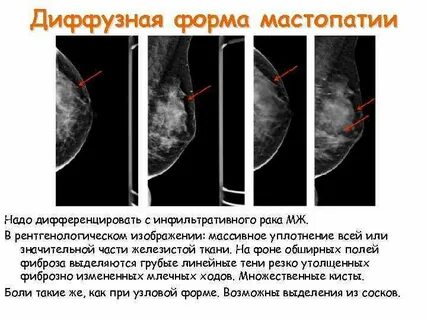 Яичники мастопатия