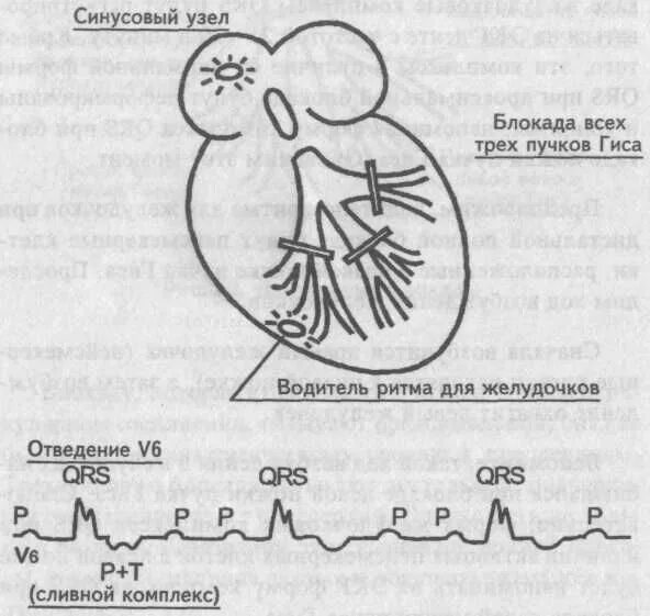 Блокада узла. Блокада синусового узла сердца. Атриовентрикулярный узел блокада. Дистальная трехпучковая блокада на ЭКГ. При АВ блокаде 3 степени ритм синусовый.