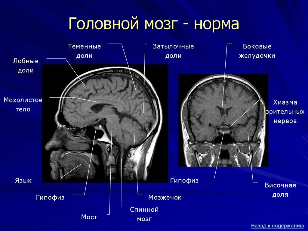 Боковые желудочки головного мозга анатомия на кт. Строение головного мозга мрт. MRT головного мозга Norma. Анатомия мозжечка мрт.