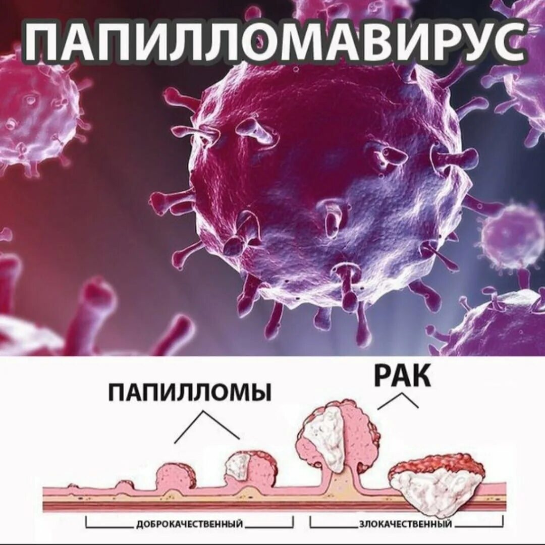 Мироспопилома человека. Попеломофирусная инфекции. Вирус human