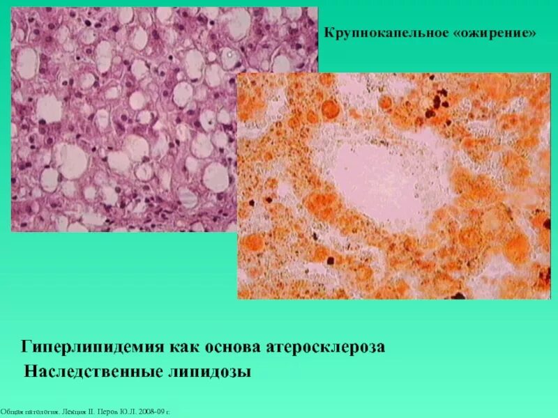 Паренхимные дистрофии. Роговая белковая дистрофия. Паренхиматозные белковые дистрофии. Зернистая дистрофия печени.