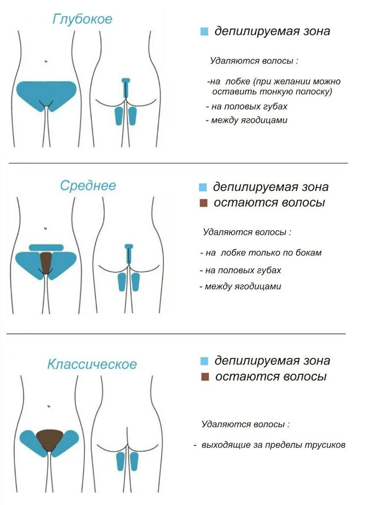 Как побрить интимную зону девушке. Зона классического бикини шугаринг. Бикини классика и глубокое отличие шугаринга схема. Зона глубокого бикини схема. Бикини лазерная эпиляция зоны схема.