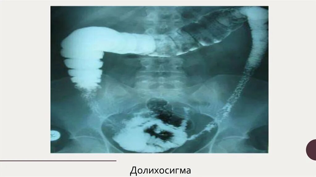 Удлиненный кишечник. Долихосигма ирригоскопия. Аномалия развития Толстого кишечника долихосигма. Ирригоскопия кишечника долихосигма. Сигмовидная кишка долихосигма.