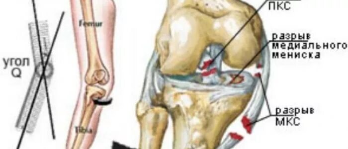 Надрыв крестообразной связки. Передняя крестообразная связка коленного сустава. Связка крестообразная связка коленного сустава. Разрыв крестообразной связки сустава колена. Пкс это.