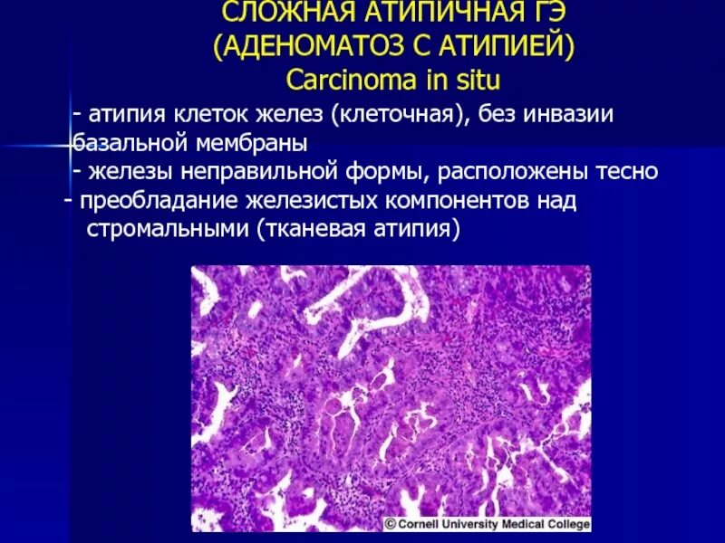 Предраковые эндометрия. Микропрепарата железистая гиперплазия эндометрия. Атипическая гиперплазия эндометрия терапия. Гиперплазия эндометрия гистология. Эндометриальный полип матки гистология.