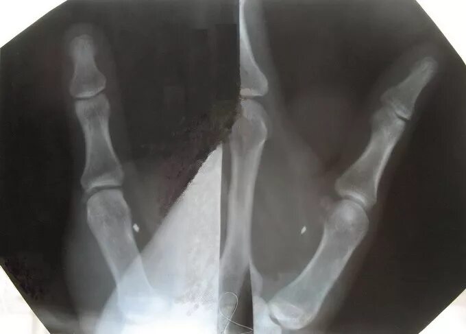 остеома ногтевой фаланги рентген. видно стекло рентген. инородное тело стекло на рентгене. видно стекло рентген. рентген.