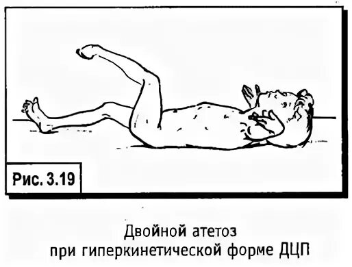 Гиперкинетическая форма дцп. Атетоидной формой детского церебрального паралича. Гиперкинетическая форма ДЦП заключение. Гиперкинетическая форма ДЦП локализация поражения.