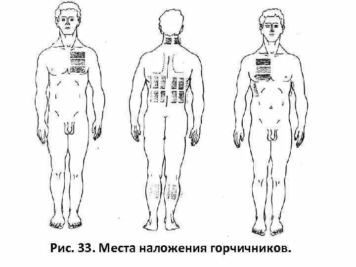 Можно ли при бронхите ставить горчичники взрослым. Места постановки горчичников. Места наложения горчичников. Горчичники схема наложения. Схема постановки горчичников.