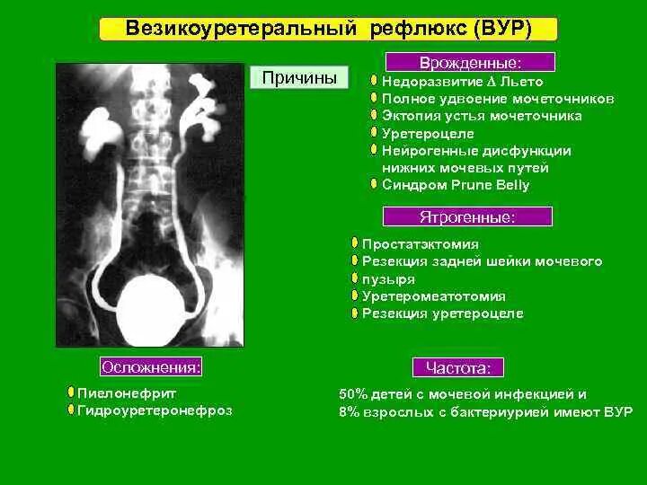 Везикуор уретральный рефлкс. Везикоуретеральный рефлюкс это. Классификация эктопии мочеточников. Врожденные аномалии мочевыводящих путей.