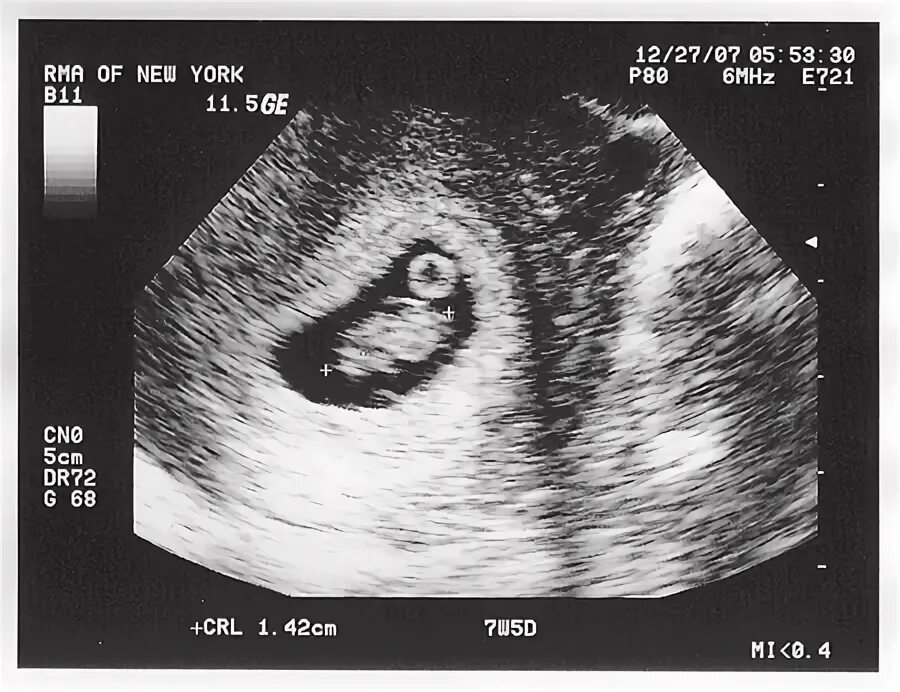 7 weeks. УЗИ на 7 акушерской неделе беременности. УЗИ на седьмой акушерской неделе беременности. УЗИ ребенка на 7 неделе беременности. УЗИ 7 недель беременности фото.