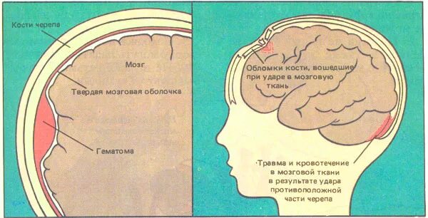 Упала затылком что делать. Ребенок стукнулся головой. Ударился/ головой затылком. Ребёнок ударился головой шишка на затылке. Малыш ударился затылком.