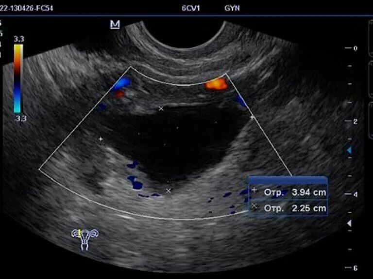 Узи день цикла. Гидросальпинкс маточных труб УЗИ. Гидросальпинкс на УЗИ. Гидросальпинкс УЗИ картина.